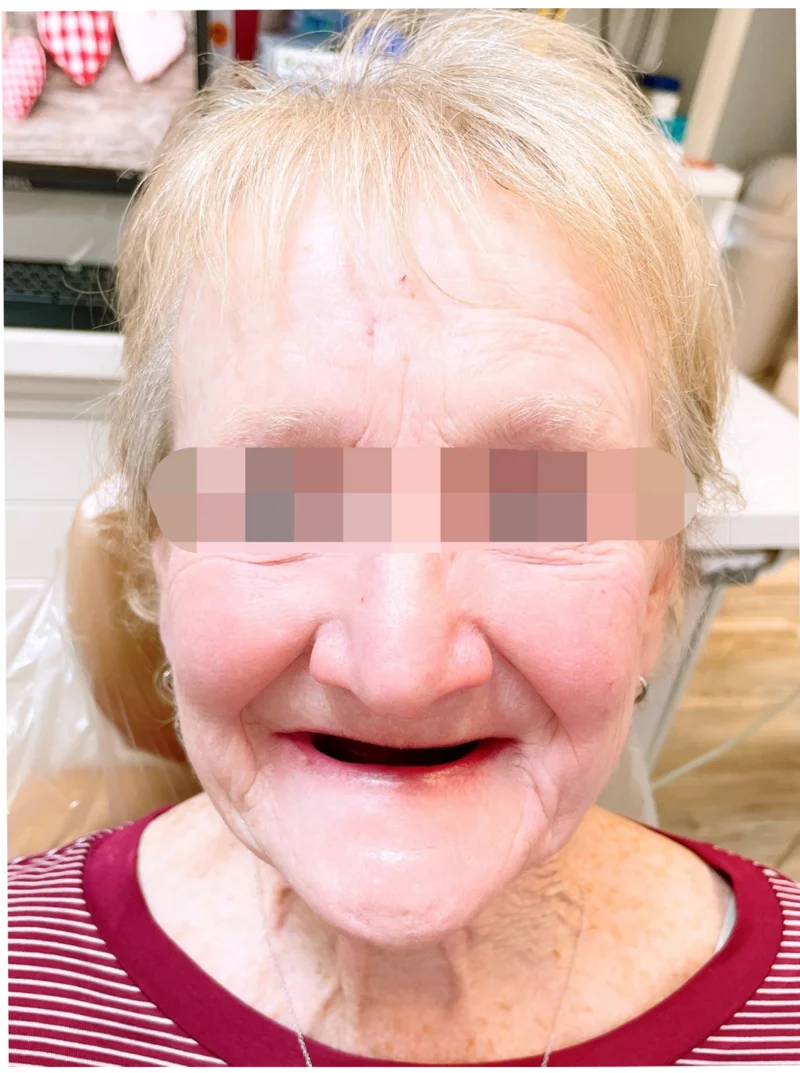 Before treatment: Teeth Restoration patient at Premier Dental