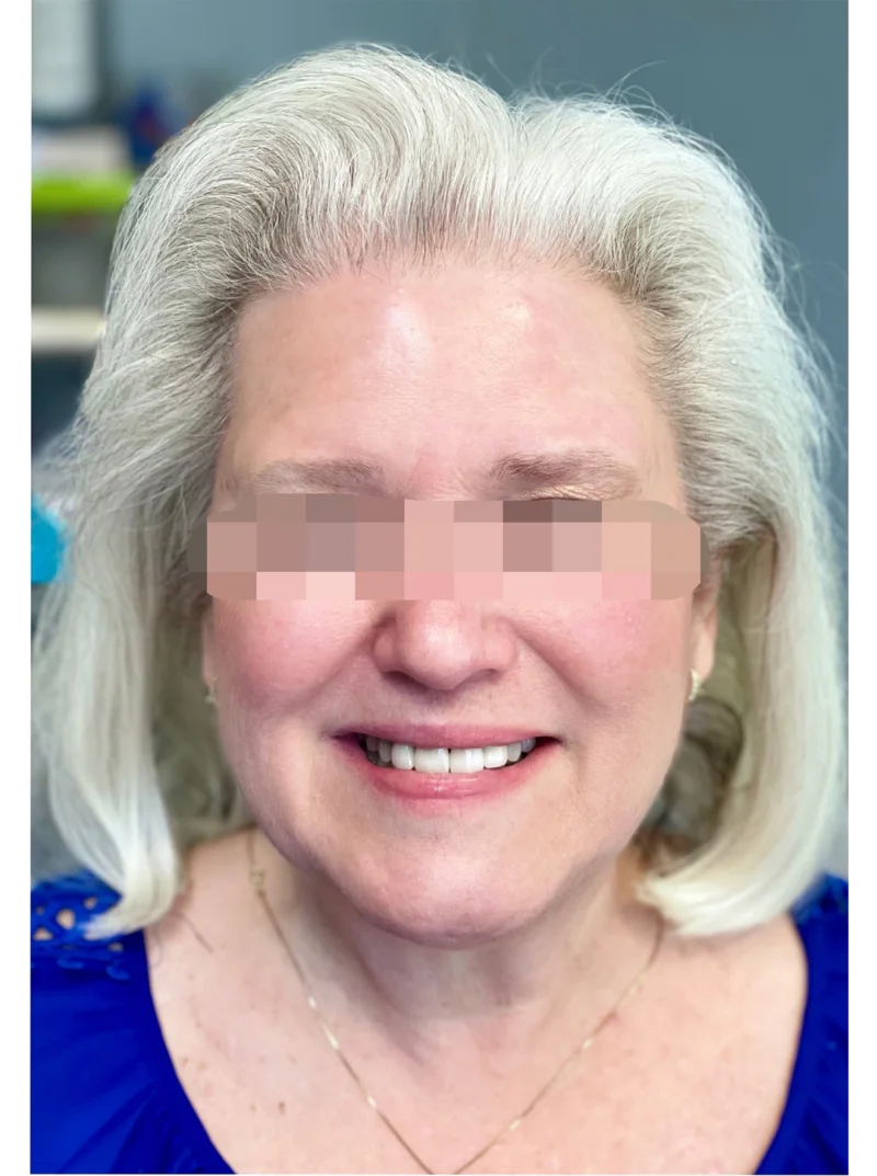 After treatment: Smile Transformation patient at Premier Dental