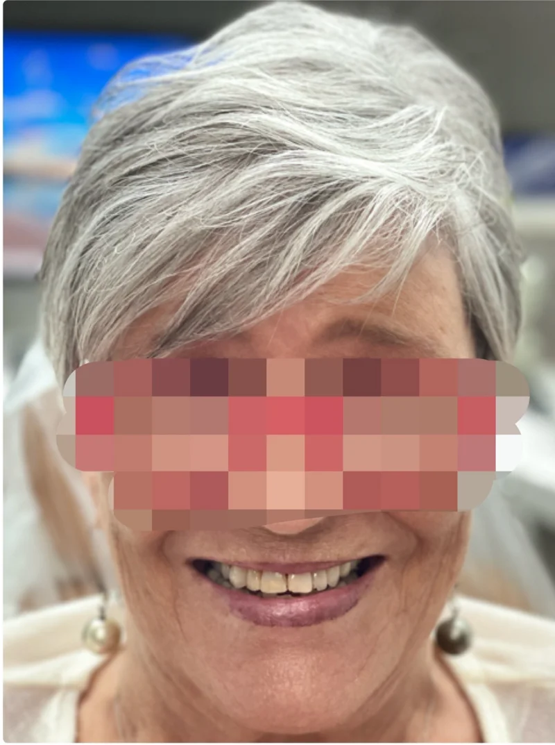 Before treatment: Restorative Dentistry patient at Premier Dental