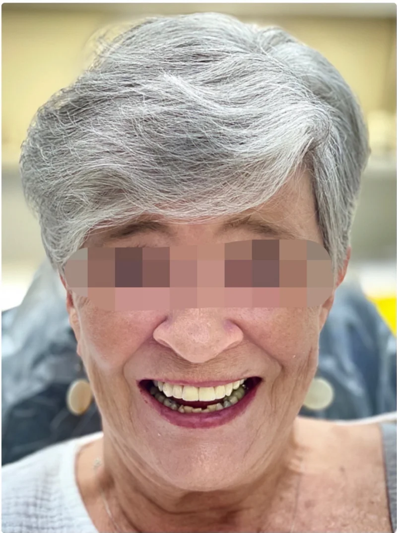 After treatment: Restorative Dentistry patient at Premier Dental