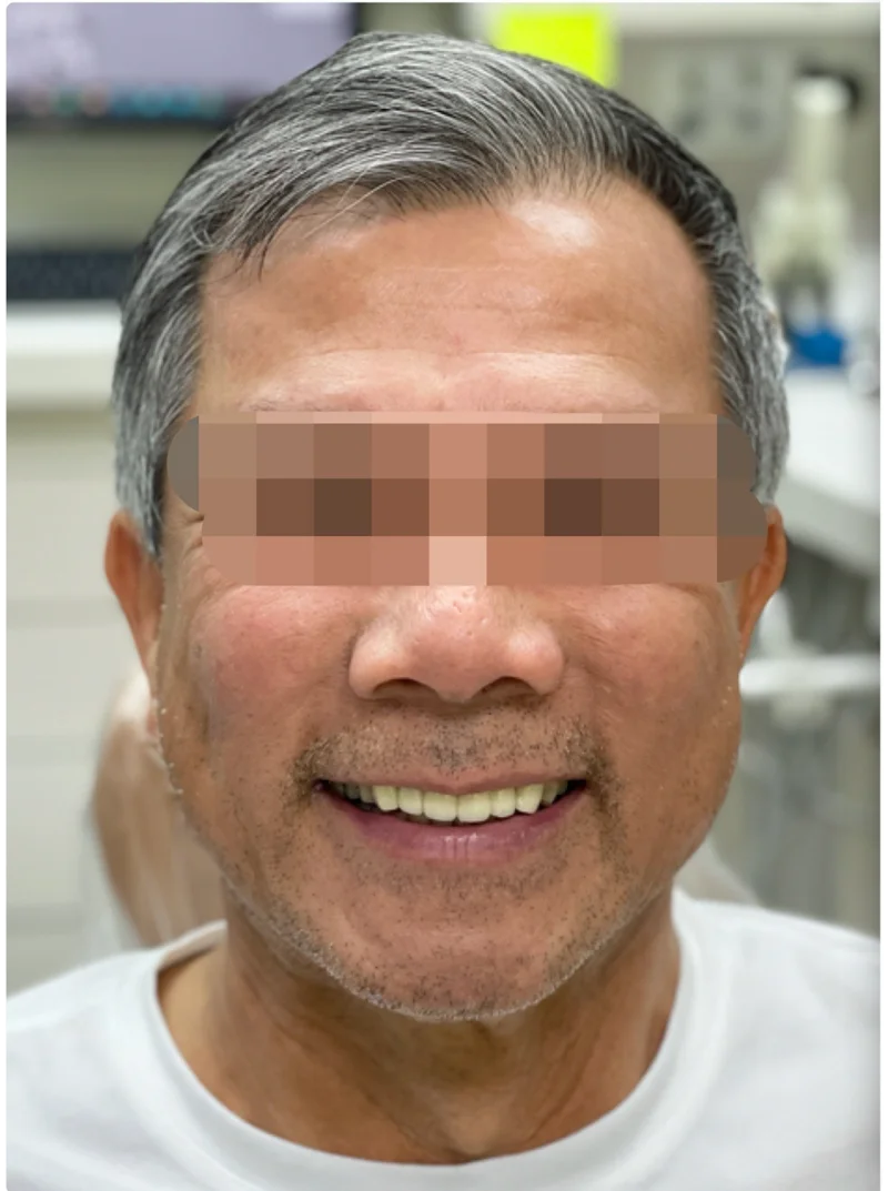 Before treatment: Crowns & Veneers patient at Premier Dental